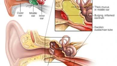 التهاب الأذن الوسطى: الأسباب والأعراض والعلاج 6 ear infection