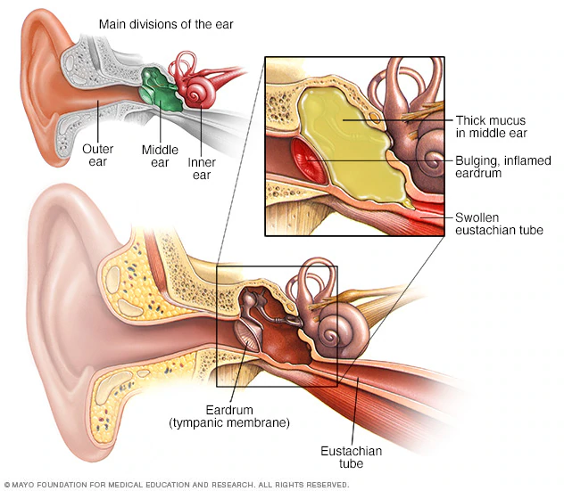 ear infection